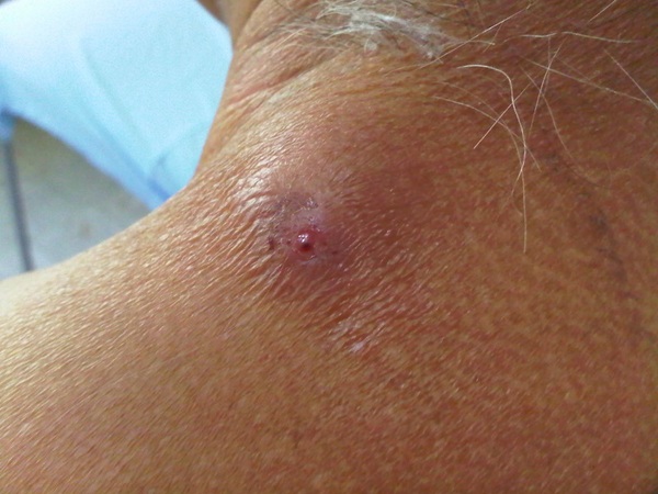 Tác nhân gây nên bệnh Myiasis