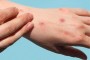 Vết cắn của bọ chét